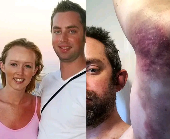 Man Reveals How He Wore Makeup for 20 Years to Hide Bruises from Wife’s Beatings